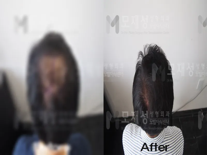 FUE移植2300个毛囊单位的术前术后照片 已遮挡的术前照片与术后照片
