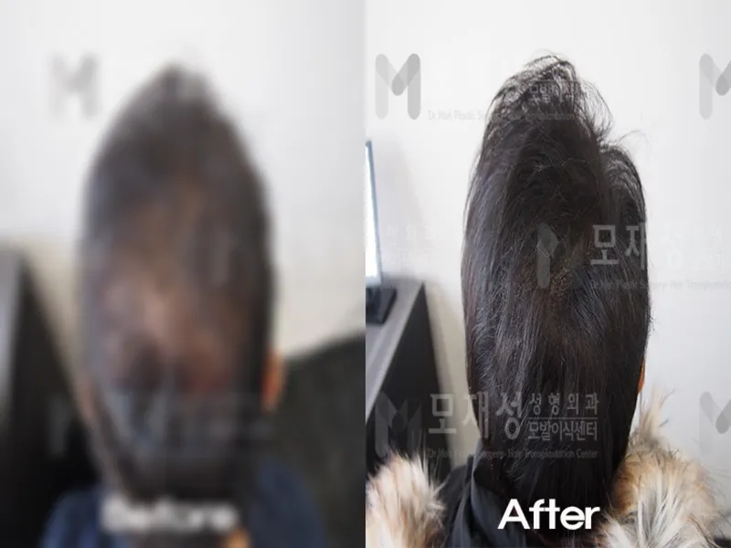 頭皮アートメイク（頭皮色素療法、scalp micropigmentation）施術前・施術後 ぼかした術前写真と術後写真