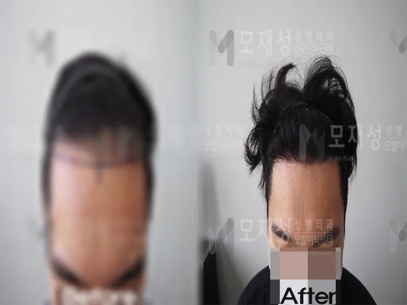 비절개 1,500모낭 전후사진 가려진 수술 전 사진과 수술 후 사진