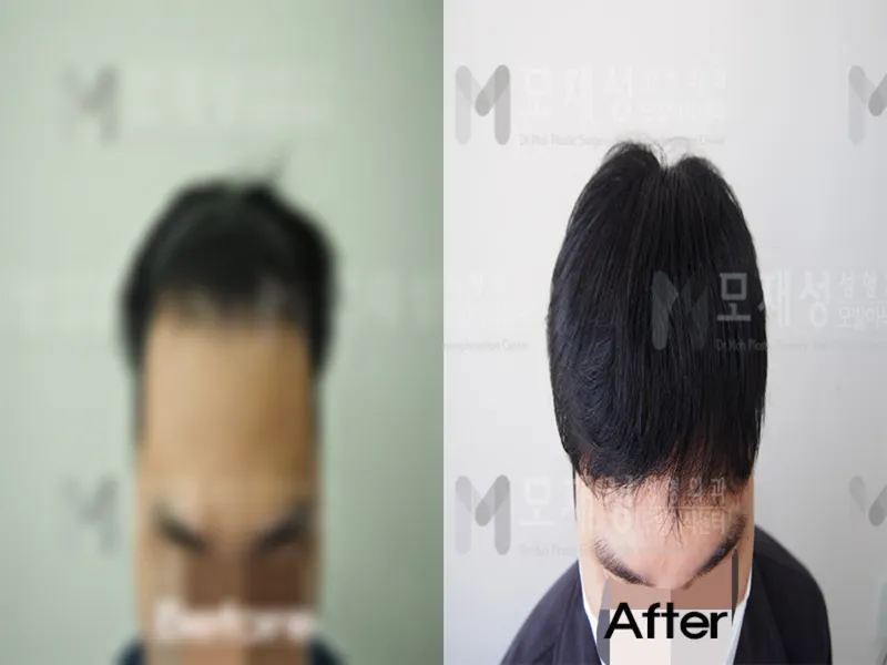 비절개 1,500모낭 전후사진 가려진 수술 전 사진과 수술 후 사진