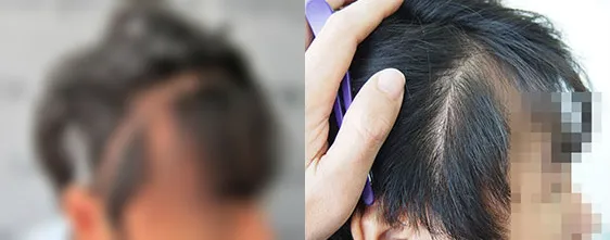 脳手術後に残った頭皮の傷跡 FUE法による自毛植毛の術前・術後比較