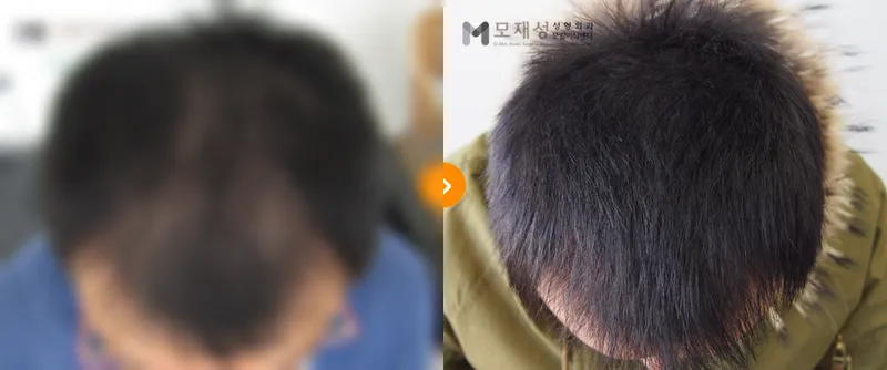頭皮色素療法の施術前・施術後症例1