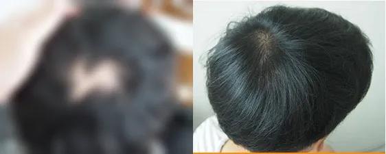 头皮裂伤瘢痕FUE毛发移植术前术后对比
