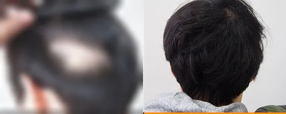 其他医院FUT毛发移植后后枕部瘢痕FUE毛发移植术前术后对比