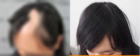 大面积烧伤瘢痕FUE毛发移植术前术后对比