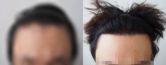 遮盖额头缩小手术瘢痕的FUE毛发移植术前术后对比