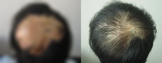 覆盖整个头顶的大面积烧伤瘢痕第一次FUE毛发移植术前术后对比